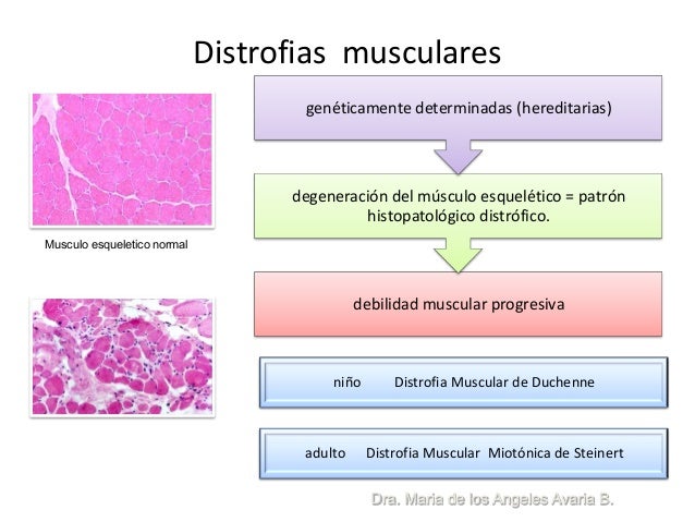 Distrofia Muscular De Steinert Download
